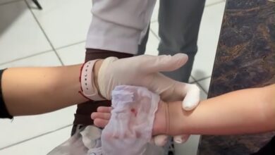 Estagiária em escola infantil queima mão de menina de 2 anos