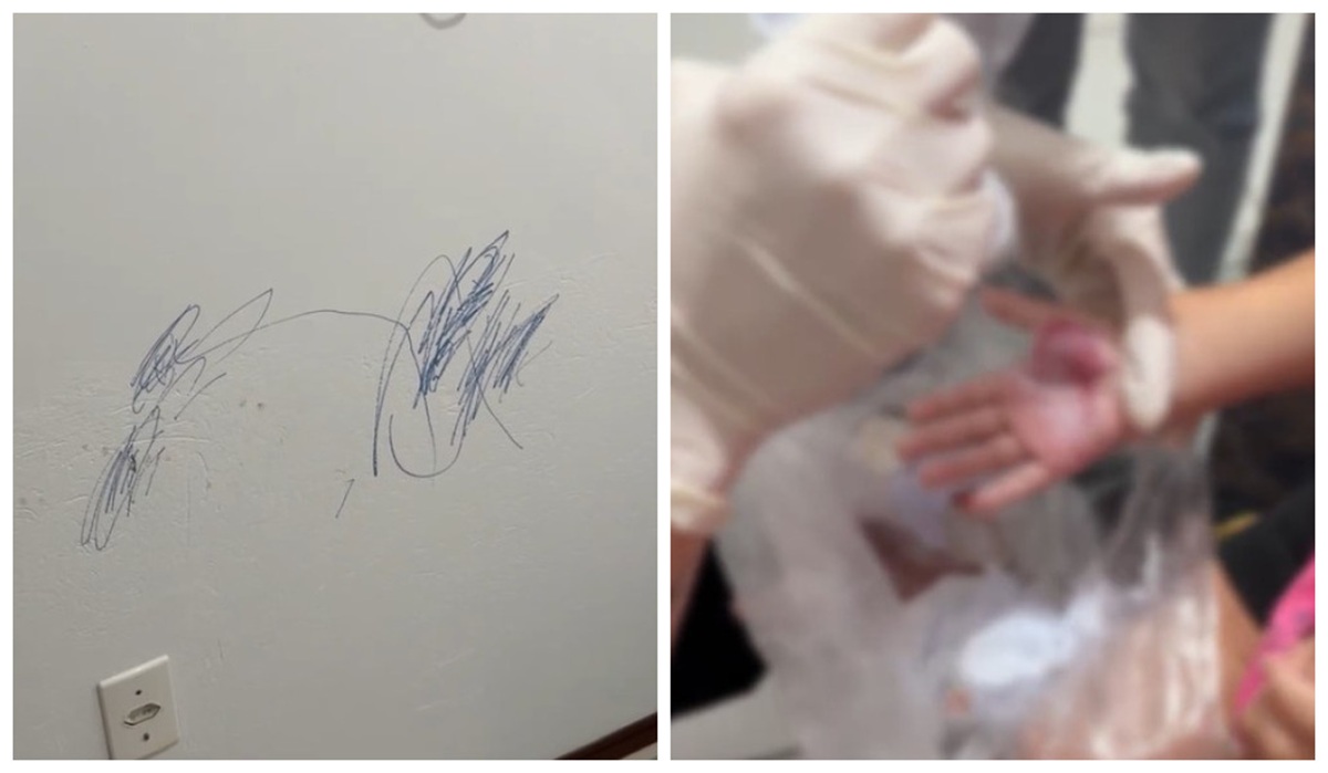 Caso de menina de 2 anos queimada pela madrasta é investigado pela Polícia Civil