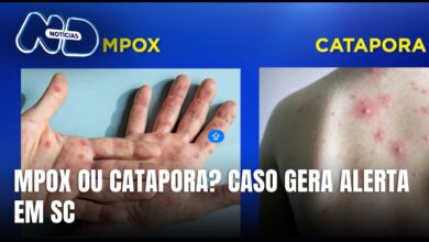 Técnico de enfermagem em Itajaí é diagnosticado com catapora após suspeita de mpox